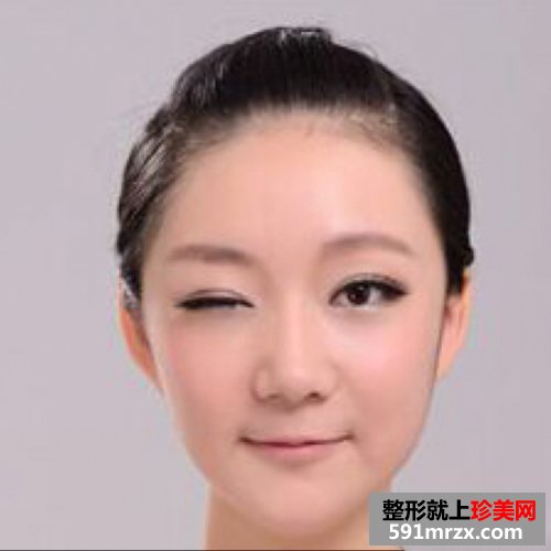 去下颌角,磨骨手术对比照片 圆脸变瓜子脸
