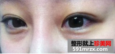 怎样快速消除熊猫眼,激光治疗黑眼圈