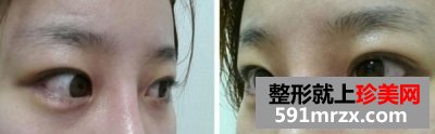 怎样快速消除熊猫眼,激光治疗黑眼圈