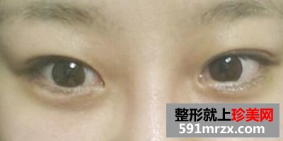 怎样快速消除熊猫眼,激光治疗黑眼圈