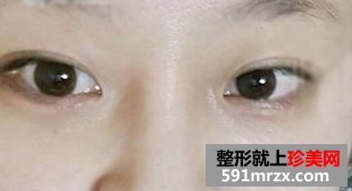 怎样快速消除熊猫眼,激光治疗黑眼圈