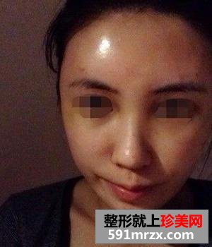 自体脂肪移植丰脸