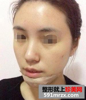 自体脂肪移植丰脸