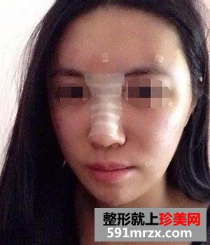 自体脂肪移植丰脸