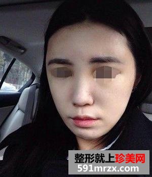 自体脂肪移植丰脸