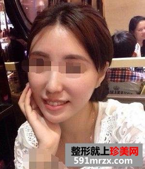 自体脂肪丰太阳穴,自体脂肪丰额头,自体脂肪丰苹果肌,自体脂肪移植丰脸