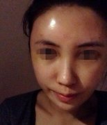 自体脂肪移植丰脸追求美丽的脚步不能停