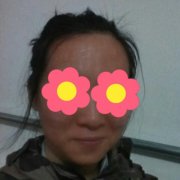 做了点阵激光祛痘坑效果很好好开森