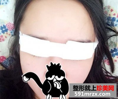 埋线法双眼皮