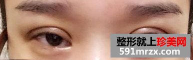 埋线法双眼皮