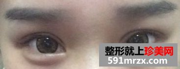 埋线法双眼皮