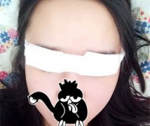 埋线法双眼皮案例