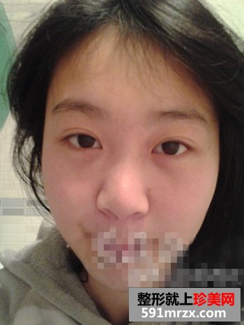 彩光去雀斑