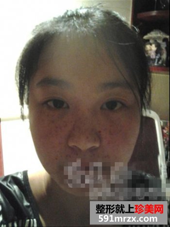 彩光去雀斑