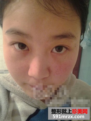 彩光去雀斑