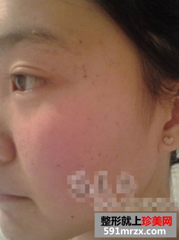 彩光去雀斑