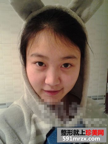 彩光去雀斑