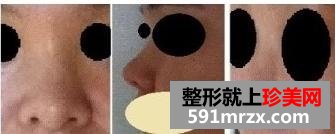 朝天鼻矫正术