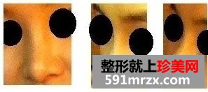 朝天鼻矫正术