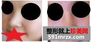 朝天鼻矫正术