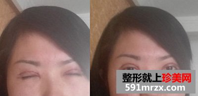 做了开眼角手术整形，我也爱上了自拍