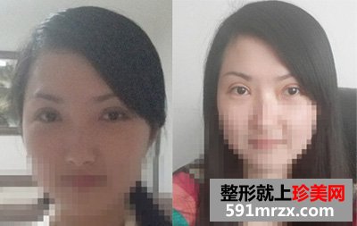 做了开眼角手术整形，我也爱上了自拍