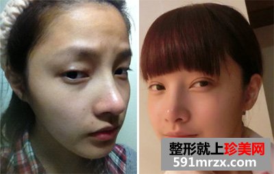生物焊接双眼皮，让我整个人的面部都明亮起来
