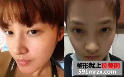 生物焊接双眼皮，让我整个人的面部都明亮起来
