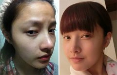 生物焊接双眼皮，让我整个人的面部都明亮起来