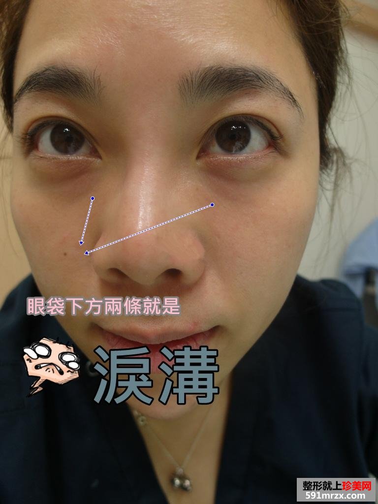 做了眼袋去除手术 对术后效果非常满意