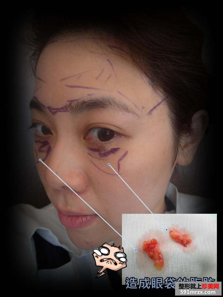 做了眼袋去除手术 对术后效果非常满意