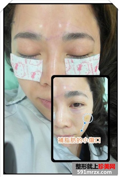 做了眼袋去除手术 对术后效果非常满意