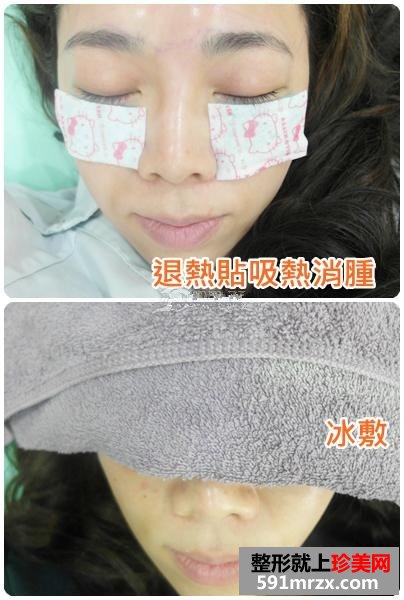 做了眼袋去除手术 对术后效果非常满意