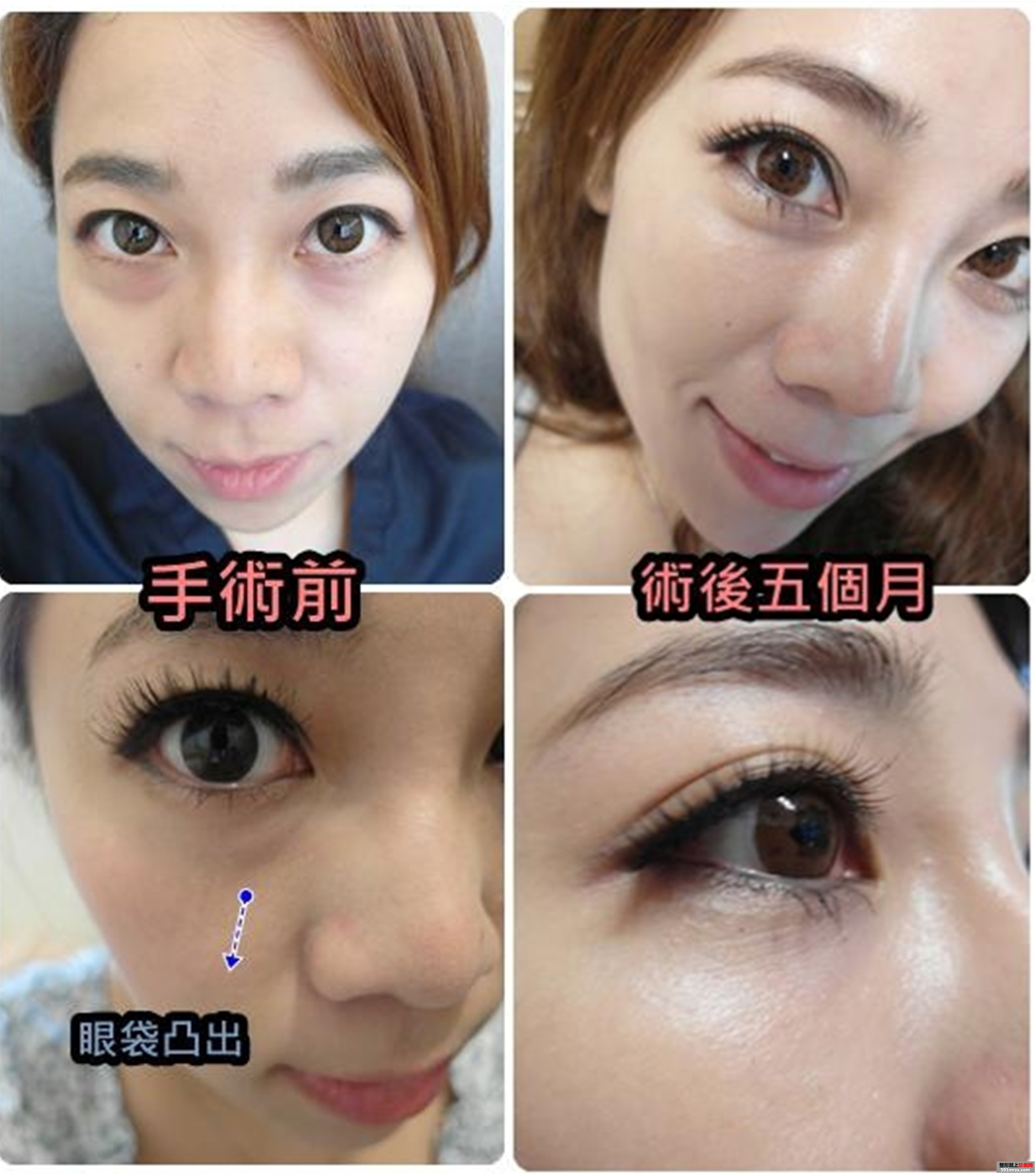 做了眼袋去除手术 对术后效果非常满意