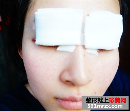 做了双眼皮开眼角手术 美丽没有后顾之忧