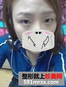 激光去眼袋 让我如愿做个美美的新娘