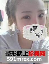 激光去眼袋 让我如愿做个美美的新娘