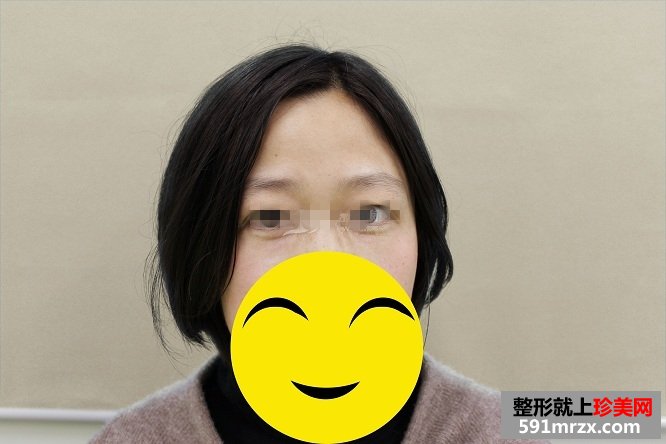 祛眼袋手术 找回了年轻的感觉