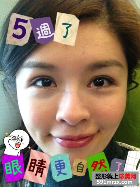 韩式双眼皮手术 给了我人生很大的改变