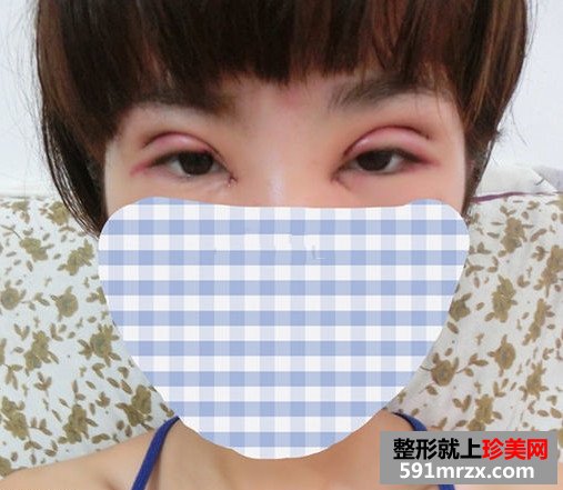 双眼皮失败修复 给我更好看的双眼皮
