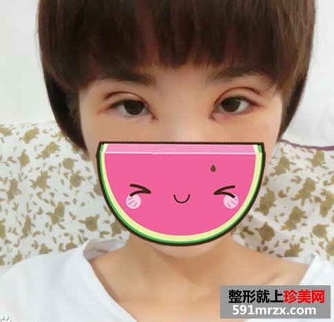 双眼皮失败修复 给我更好看的双眼皮