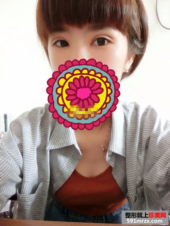 双眼皮失败修复 给我更好看的双眼皮