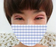 双眼皮失败修复给我更好看的双眼皮