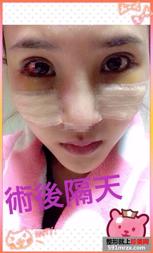 内双做双眼皮手术 我的眼晴变大啦