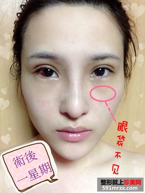 内双做双眼皮手术 我的眼晴变大啦
