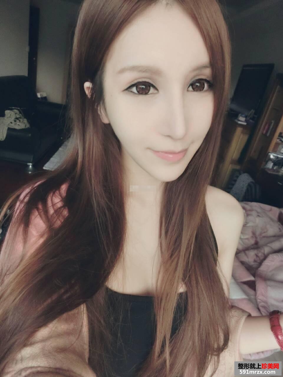 看看我的开眼角前后对比照片 眼睛更有神韵了哟