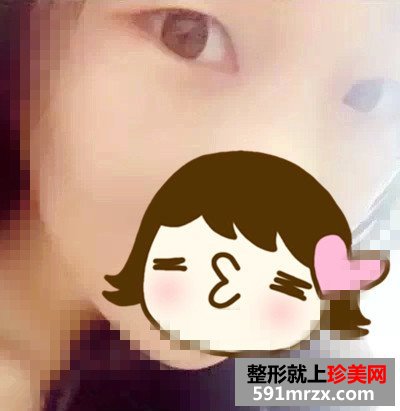 芭比娃娃双眼皮前后对比效果图片和恢复过程