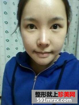 V-Line整形磨骨手术最新案例真人分享前后对比照