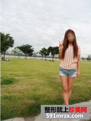 大腿部吸脂减肥效果图 大腿抽脂真实经历