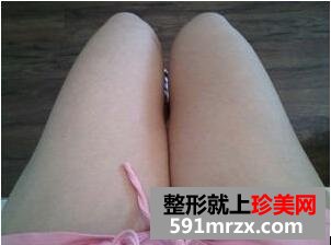 大腿部吸脂减肥效果图 大腿抽脂真实经历